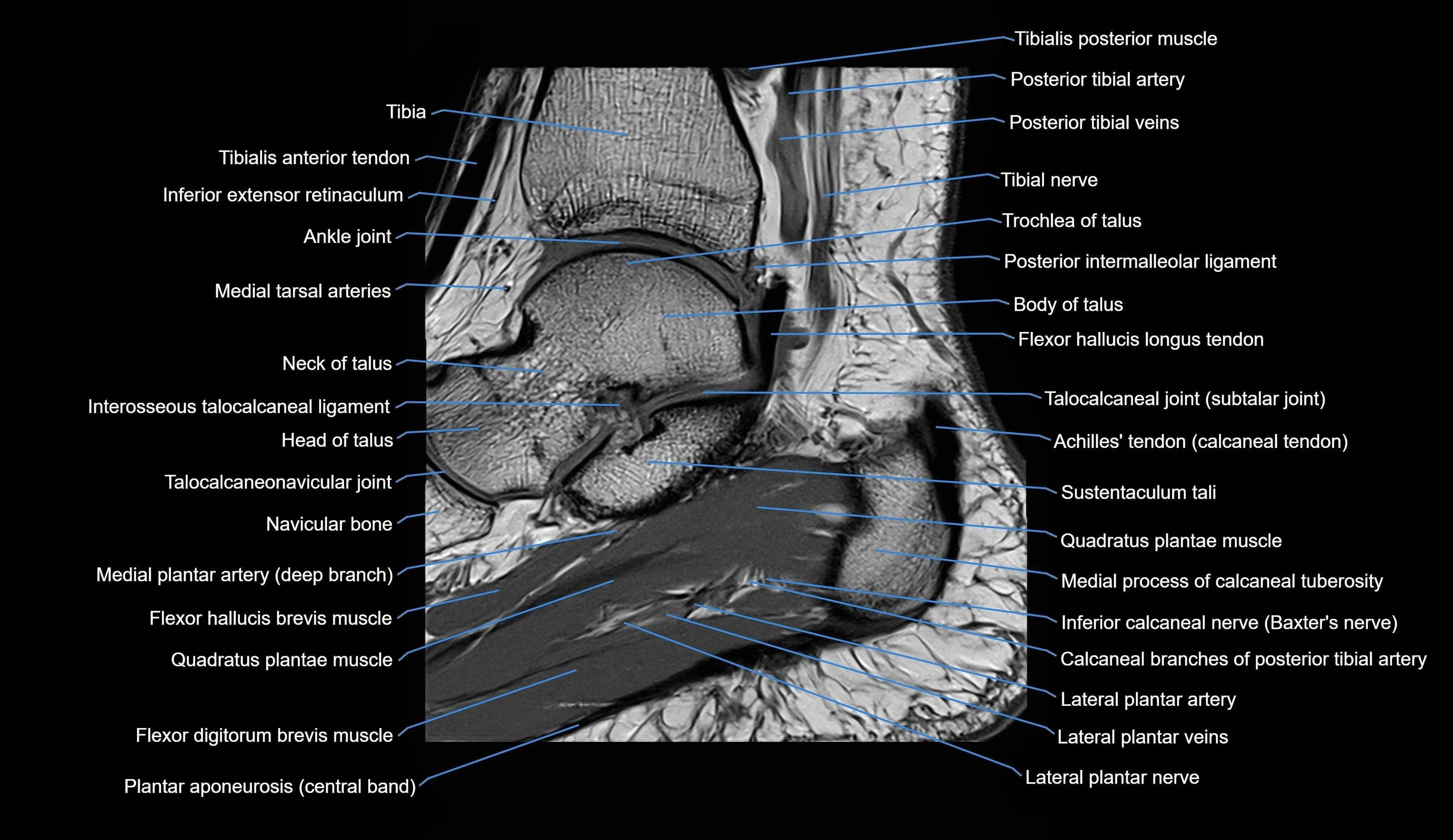 MRI Ankle sagittal cross sectional anatomy 3T  radiology  image-img-00001-00014.webp